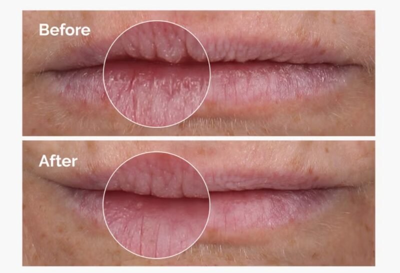 The Ordinary PHA 5% Exfoliating Lip Serum -15ml