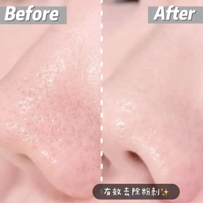 Dong-A Pharmaceutical Aclean Gel a treatment for acne 20g